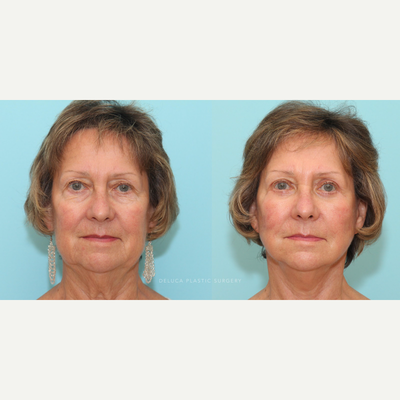Facelift before and after photo