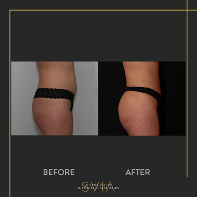 Brazilian Butt Lift before and after photo