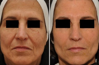 Restylane before and after photo