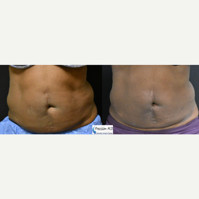 CoolSculpting before and after photo
