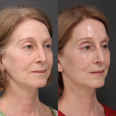 Brow Lift before and after photo