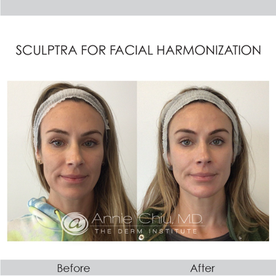 Sculptra before and after photo