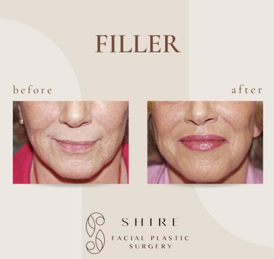 Dermal Fillers before and after photo