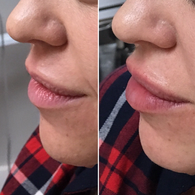 Restylane Silk before and after photo