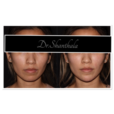 Chin Filler before and after photo