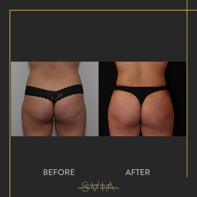Brazilian Butt Lift before and after photo