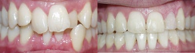 Braces before and after photo