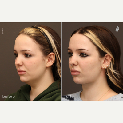 Neck Lift before and after photo