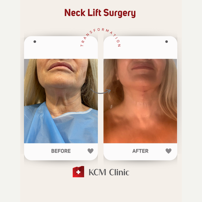 Facelift before and after photo