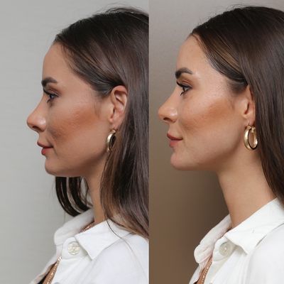 Chin Filler before and after photo