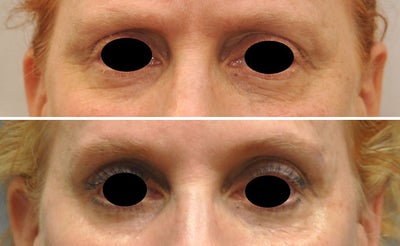 Botox before and after photo