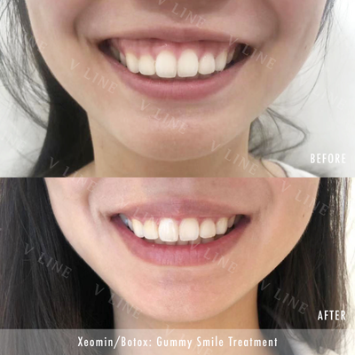 Botox for Gummy Smile before and after photo