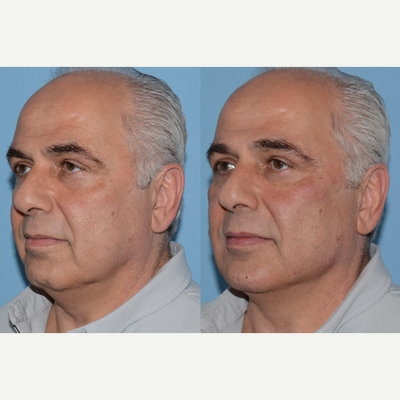 Dermal Fillers before and after photo
