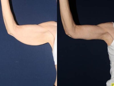 Arm Lift before and after photo