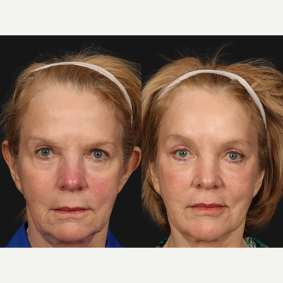 Eyelid Surgery before and after photo