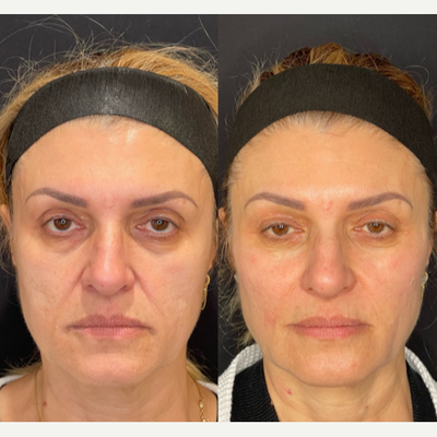 Cheek Fillers before and after photo