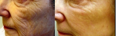 CO2 Laser before and after photo