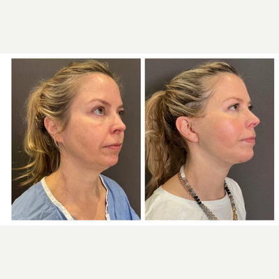 before and after image