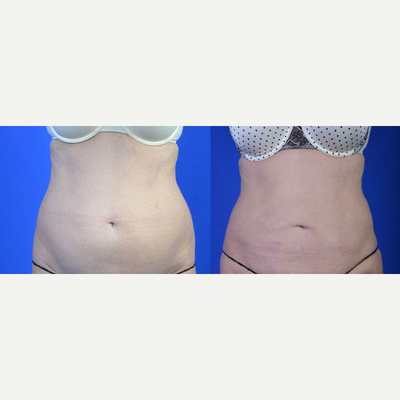 Smart Lipo before and after photo