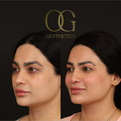 Asian Rhinoplasty before and after photo