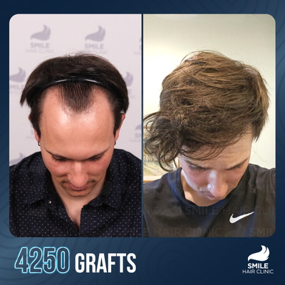 Hair Transplant before and after photo