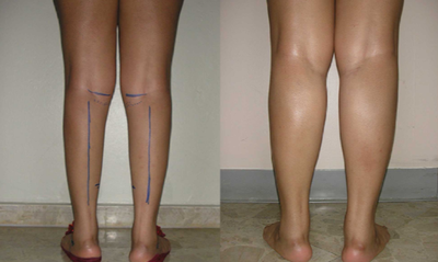 Calf Implant before and after photo