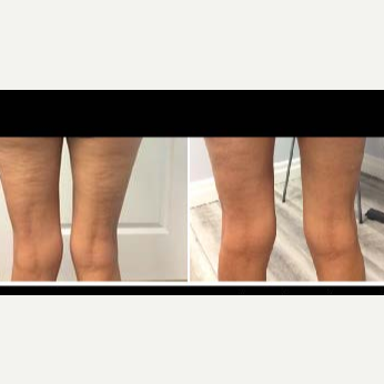 Profound RF before and after photo