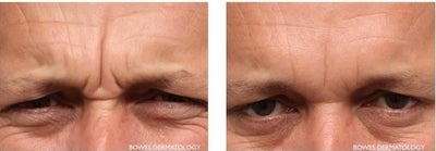 Botox before and after photo