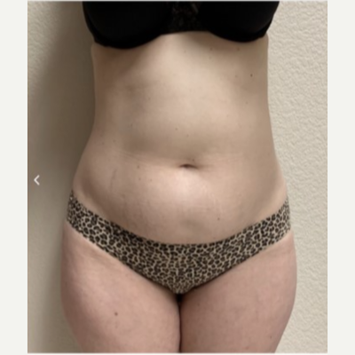 TUMMY TUCK ON A PLUS SIZE PATIENT IN GILBERT, AZ - Patient Galleries  Archive - Jude LaBarbera MD Plastic Surgery