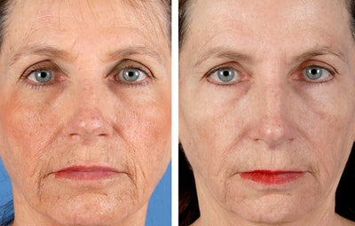 ActiveFX before and after photo