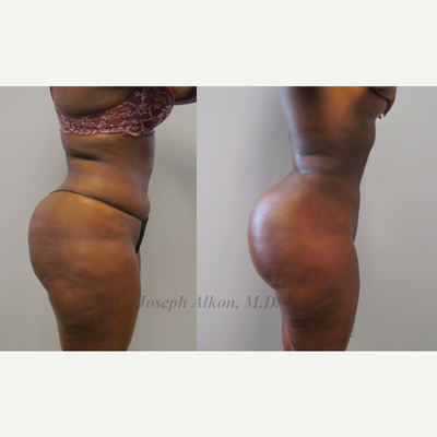 Brazilian Butt Lift before and after photo