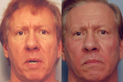 Sculptra before and after photo