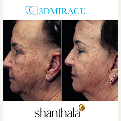 3DMIRACL before and after photo
