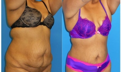 Liposuction before and after photo