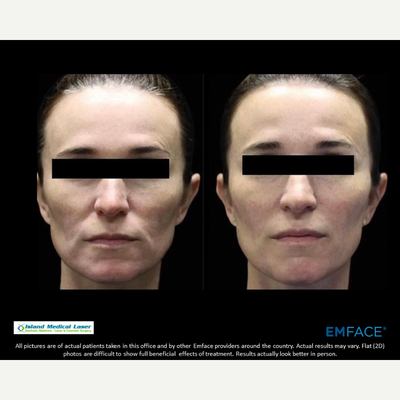Emface before and after photo