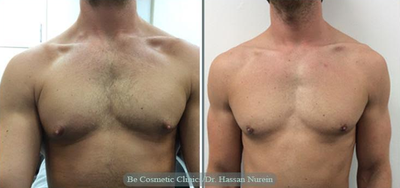 Gynecomastia Surgery before and after photo