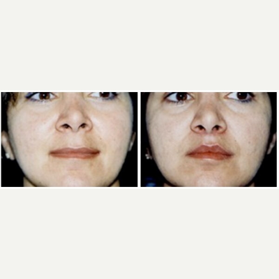 Lip Fillers before and after photo