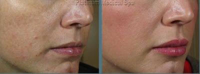 Juvederm before and after photo