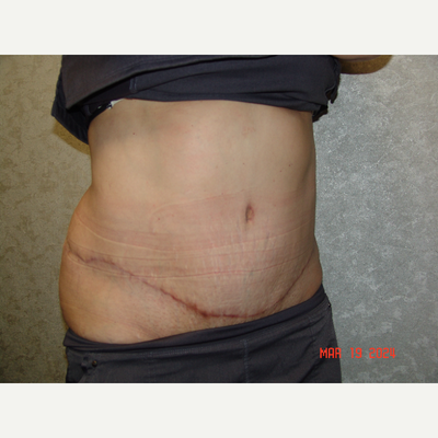 Tummy Tuck Fall River MA  Abdominoplasty to Tone Your Stomach