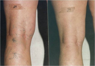 Sclerotherapy before and after photo