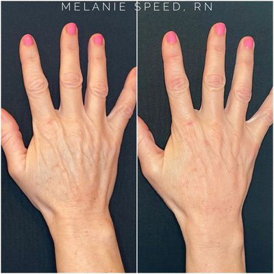 Hand Rejuvenation before and after photo