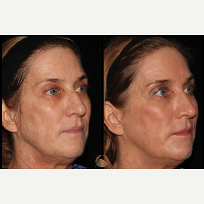 CO2RE Intima before and after photo