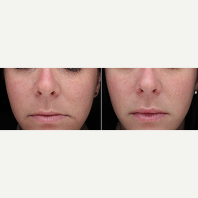 Lip Fillers before and after photo