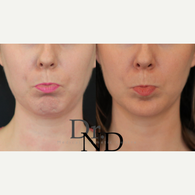Botox before and after photo