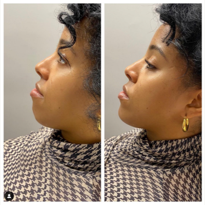Chin Filler before and after photo