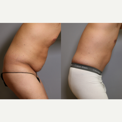 Tummy Tuck before and after photo