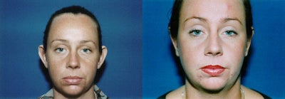 Ear Surgery before and after photo