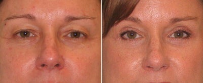 Eyelid Surgery before and after photo