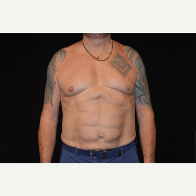 Abdominal Etching (Six Pack Abs) Maryland, Baltimore