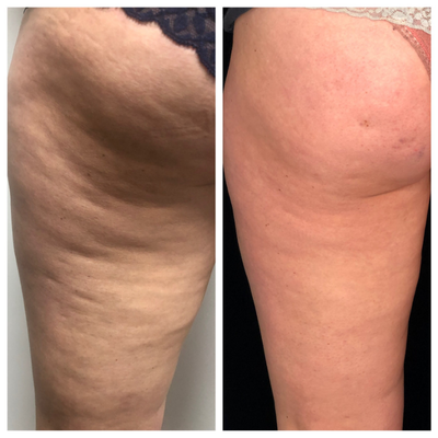 Velashape before and after photo